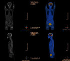 Obraz badania PET/CT 2